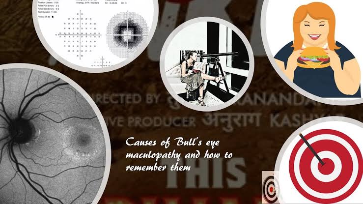 Bull's eye maculopathy: how to remember the causes (mnemonic) video