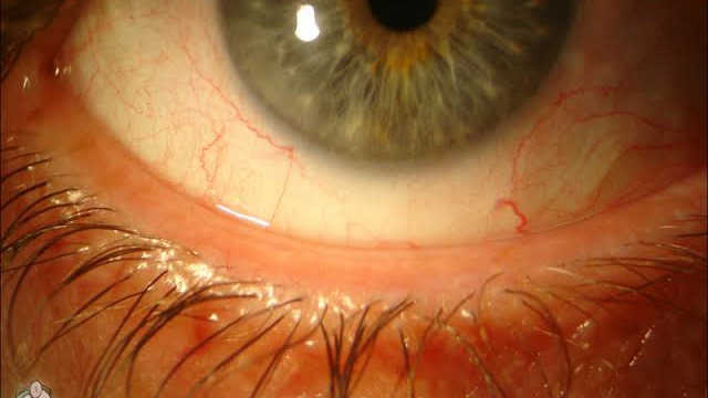 Xalatan Lash Growth video by Tim Root