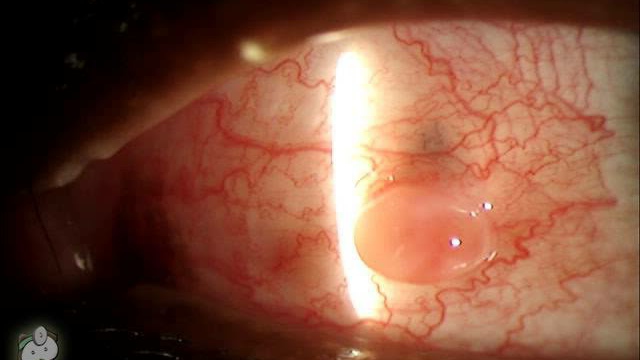 Pyogenic Granuloma on Eye Video by Tim Root