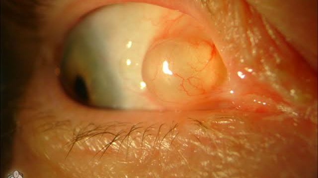 Inclusion cyst on the eye video by Tim Root