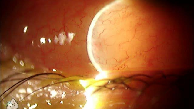 Chemosis of the eye video by Tim Root