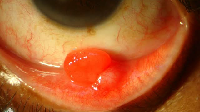 Pyogenic Granuloma on Eyelid Video by Tim Root