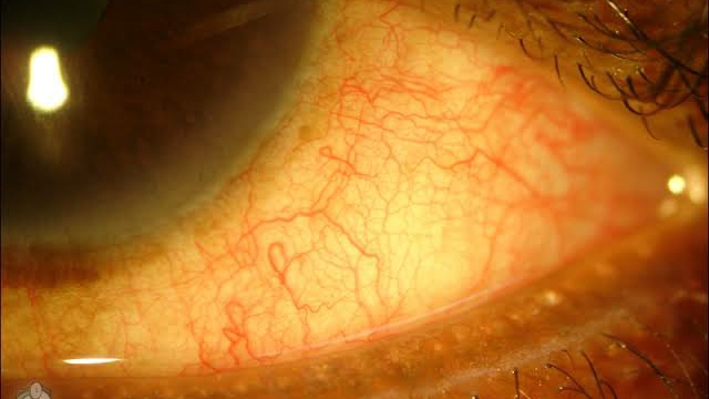 Meibomian Gland Dysfunction Video by Tim Root