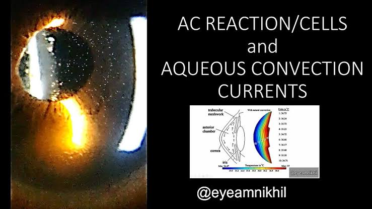 Anterior chamber cells, anterior chamber reaction and aqueous convection currents in anterior chamber video